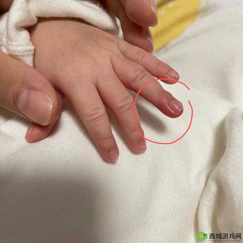 宝宝怎么才三根手指就痛:原因究竟为何